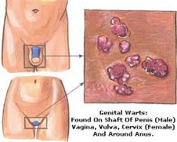 Кондиломы половых органов у мужчин и женщин