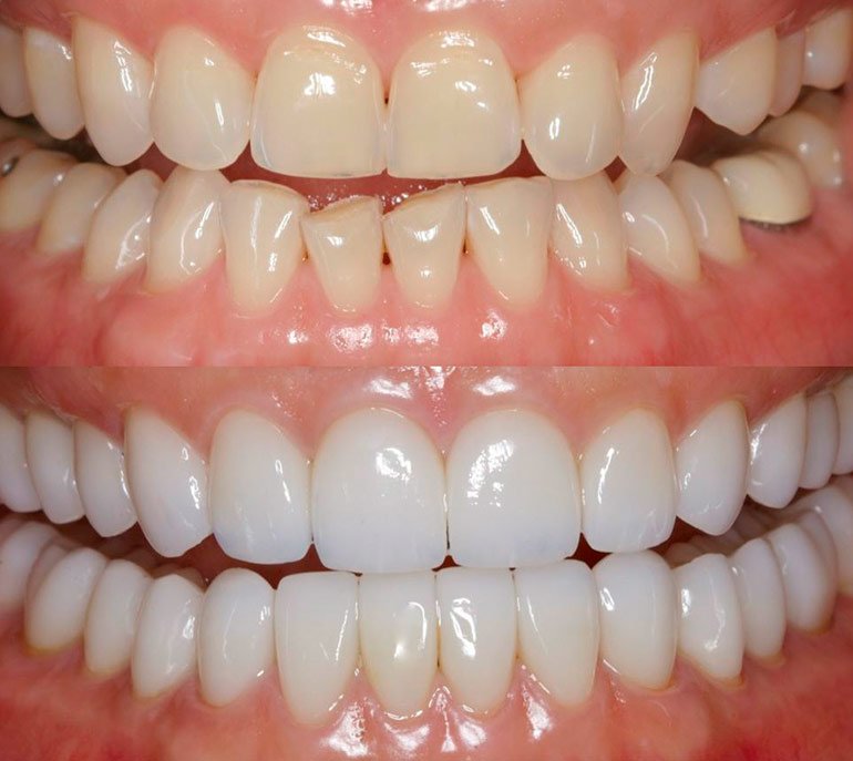 Особенности и виды художественной реставрации зубов
